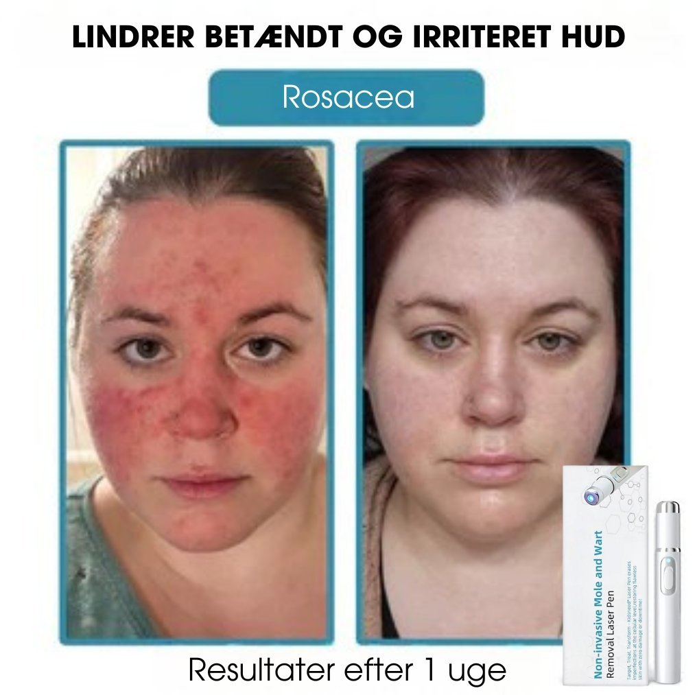 DermaLight Pro™ - Ikke-invasiv laserpen til modermærker, vorter og hudflapper