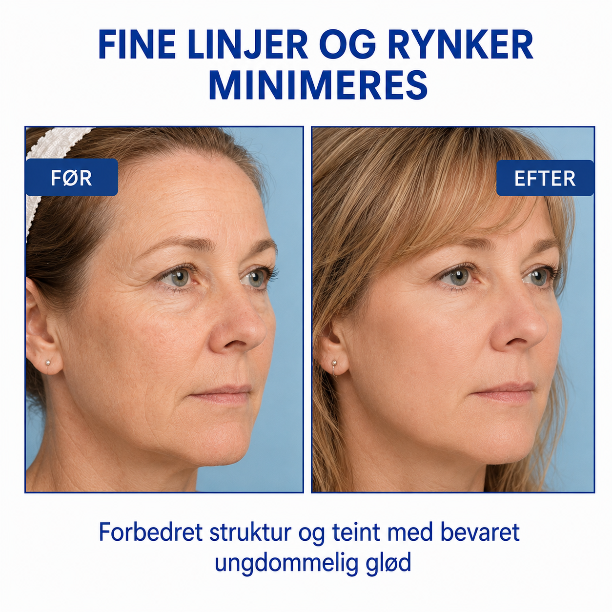 SkinLift™ | Botox-ansigtsserum