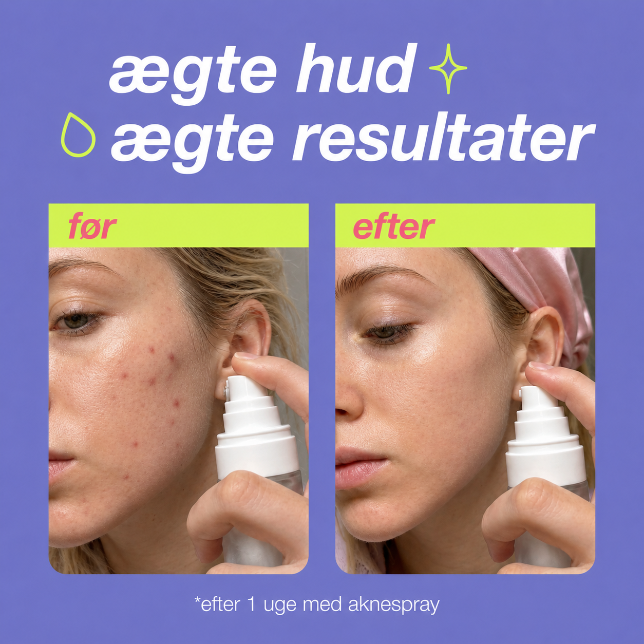 Seoul Acne Spray™