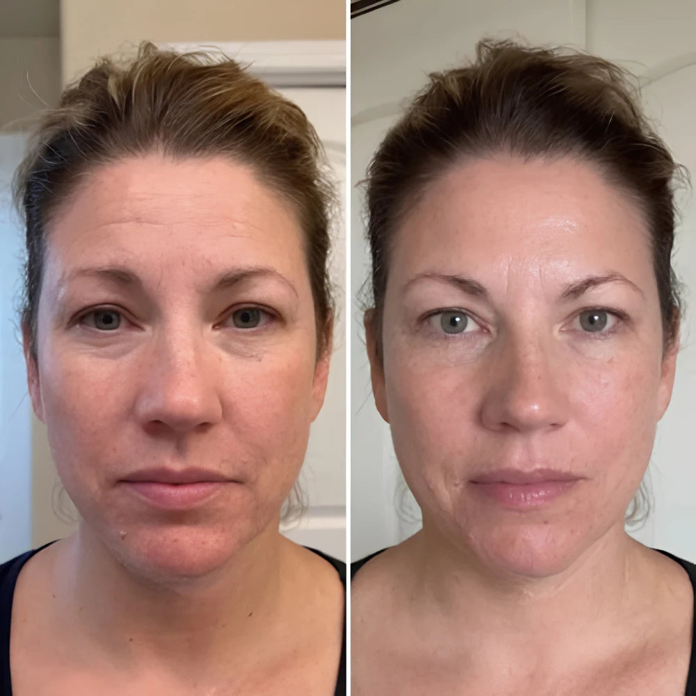 PDRN Bio-Kollagen Stift Til Målrettet Fylde Og Fasthed, before/after 4