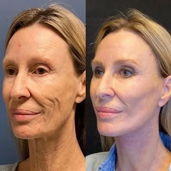 SkinLift™ | Botox-ansigtsserum