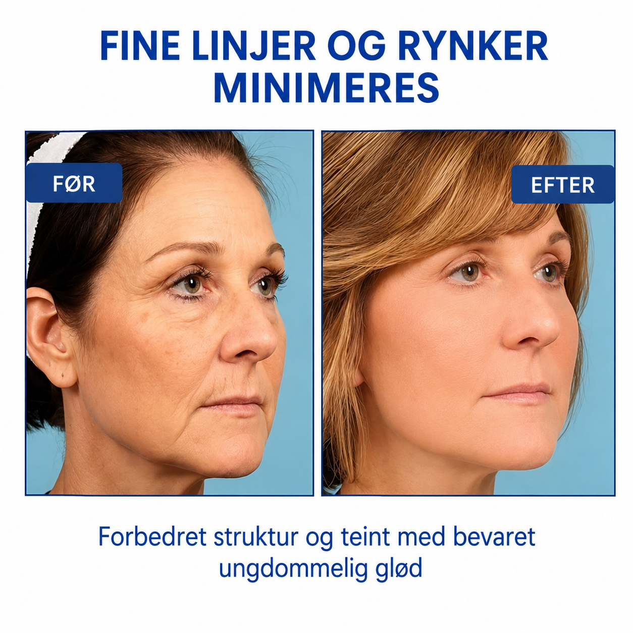 SkinLift™ | Botox-ansigtsserum