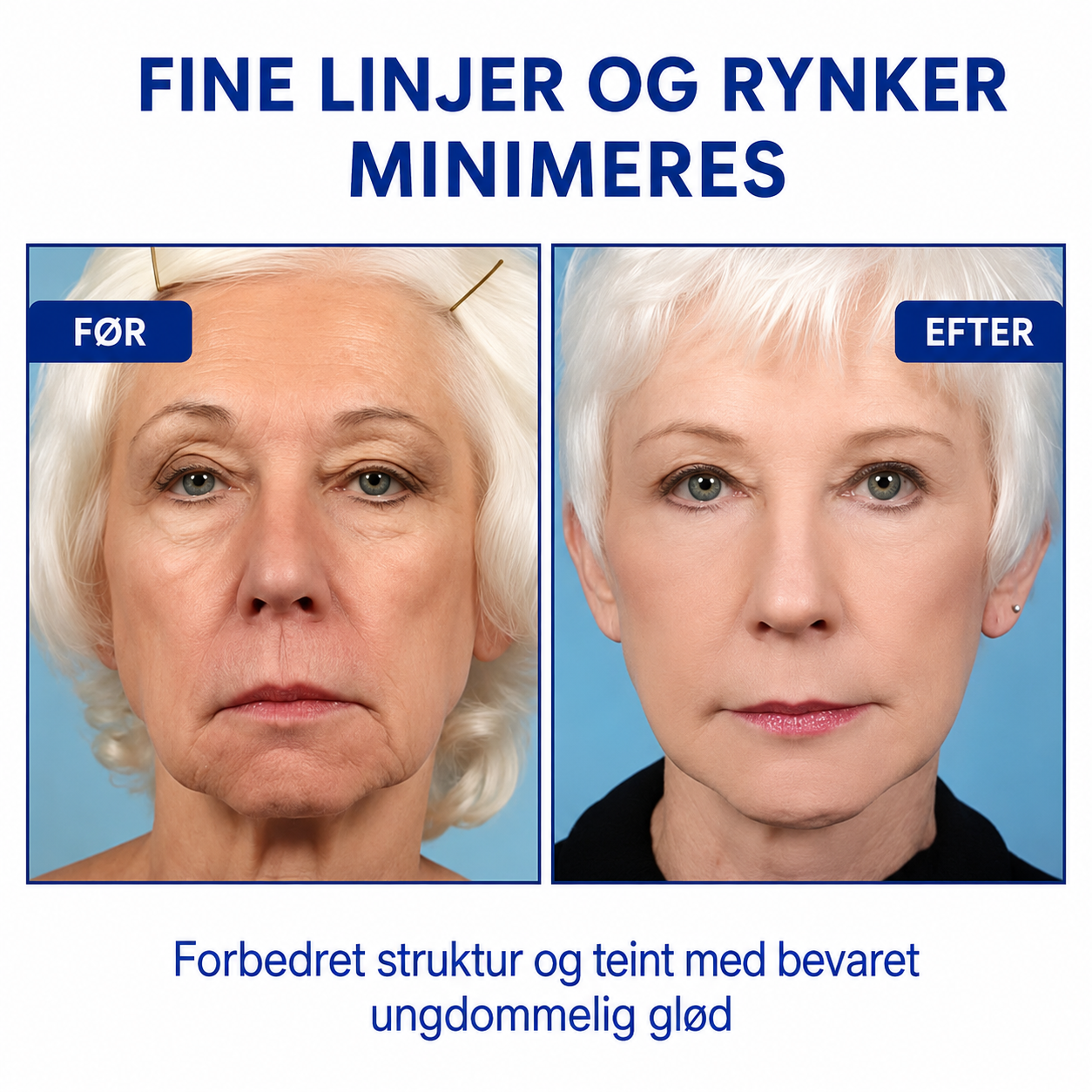 SkinLift™ | Botox-ansigtsserum