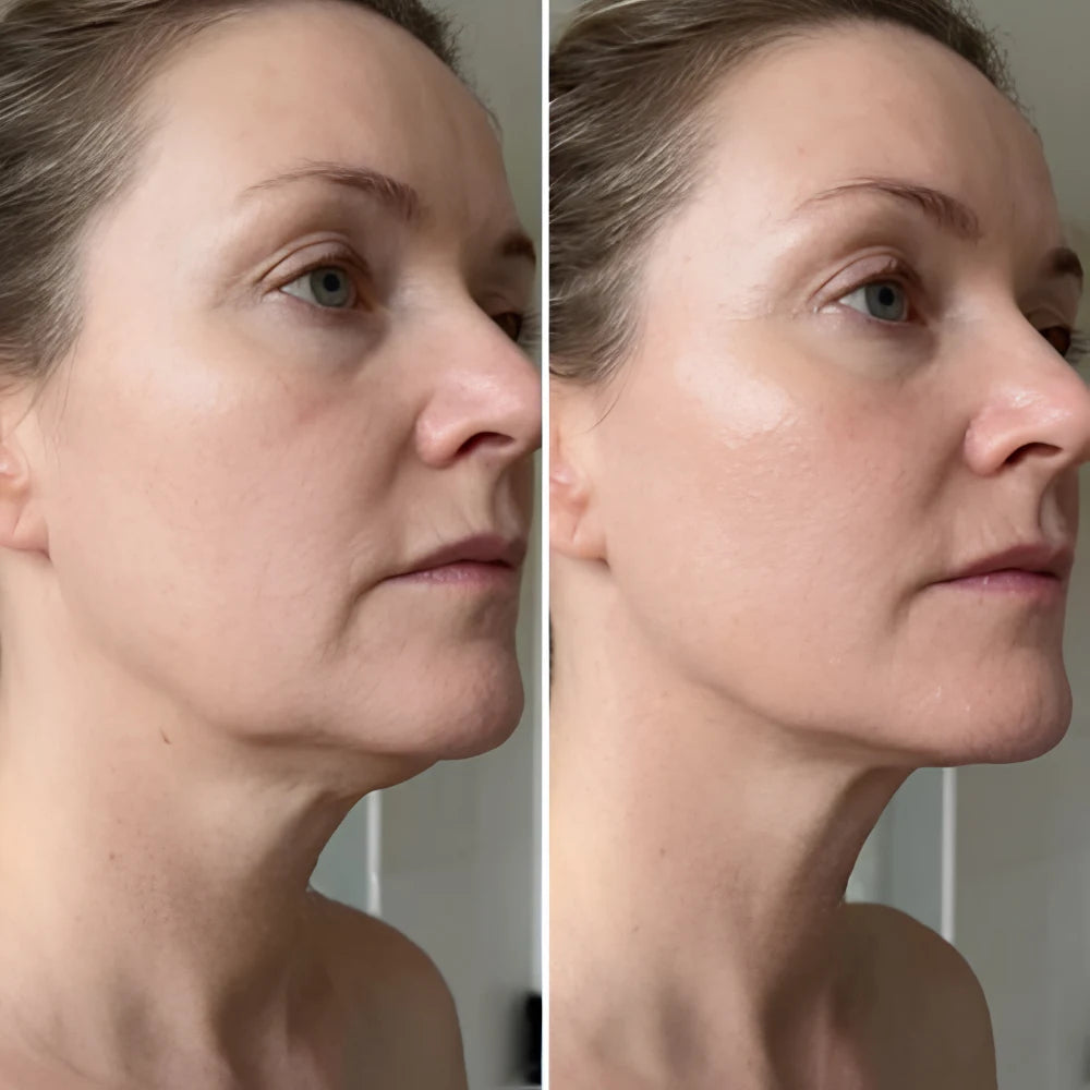Målrettet PDRN Bio-Kollagen Stift til Ansigtet, before/after 1