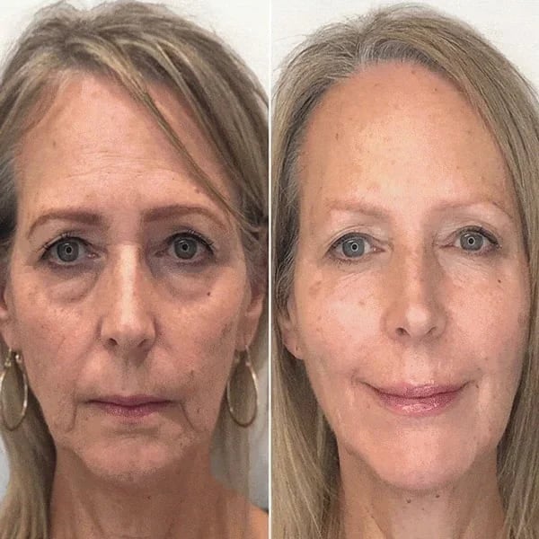 SkinLift™ | Botox-ansigtsserum